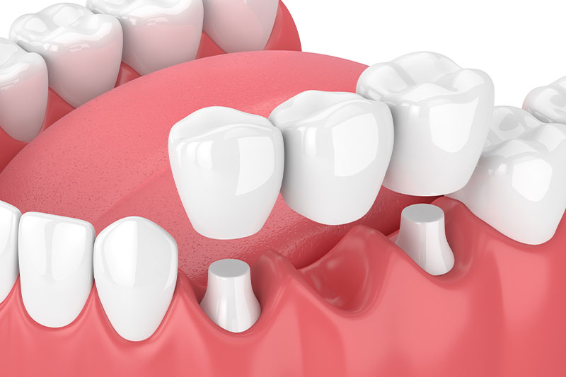 Dental Bridges in Grosse Pointe Woods