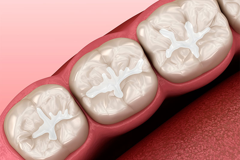 Dental Sealants in Grosse Pointe Woods