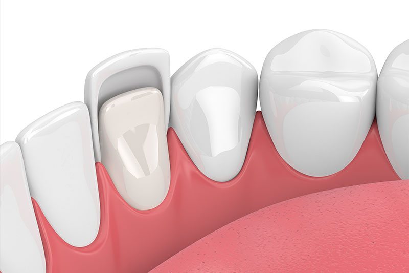 Porcelain Veneers in Grosse Pointe Woods